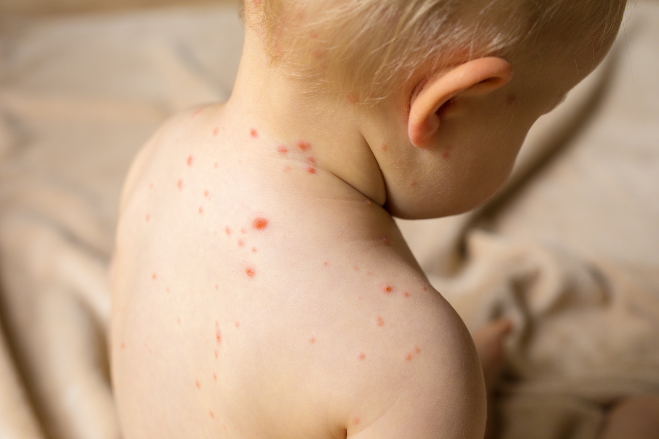 Baby with Chicken Pox